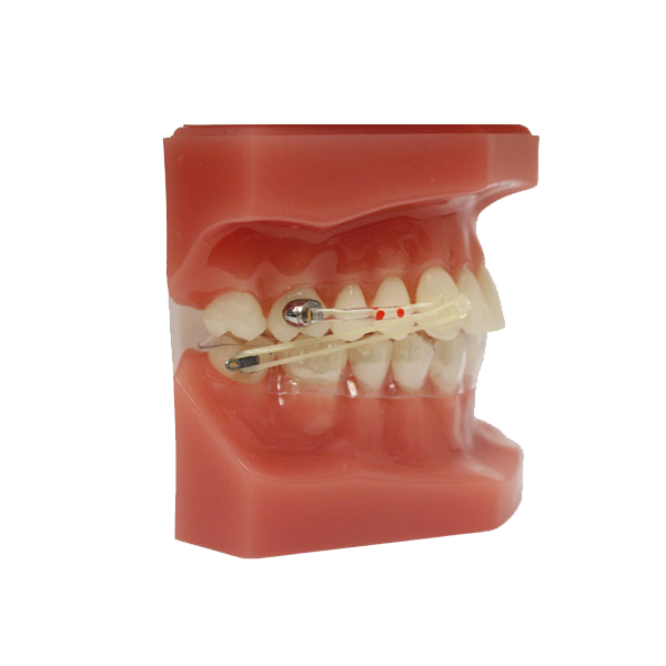 Typodont-CARRIERE® Motion Class II Metal w/Clear Aligner