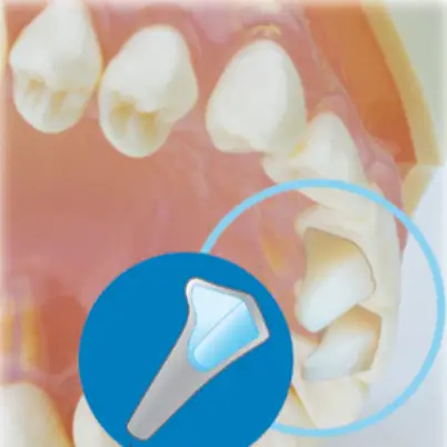 Mini Mold Anterior Bite Ramp Bonder Kit 8 Tips 7 mm Mini Mold Anterior Bite Ramp Bonder Kit 8 Tips 7 mm